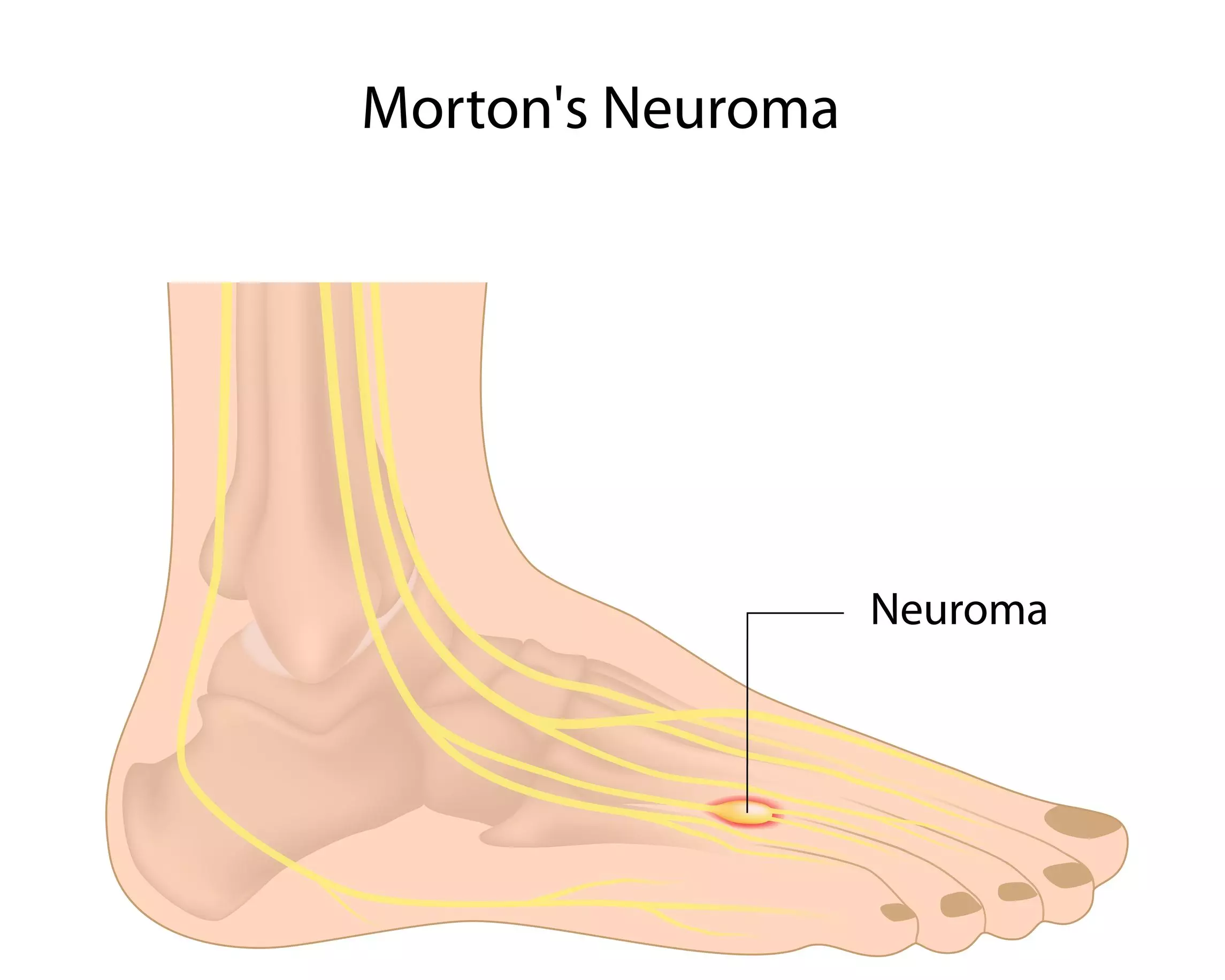 ¿Sabes qué es el neuroma de Morton?