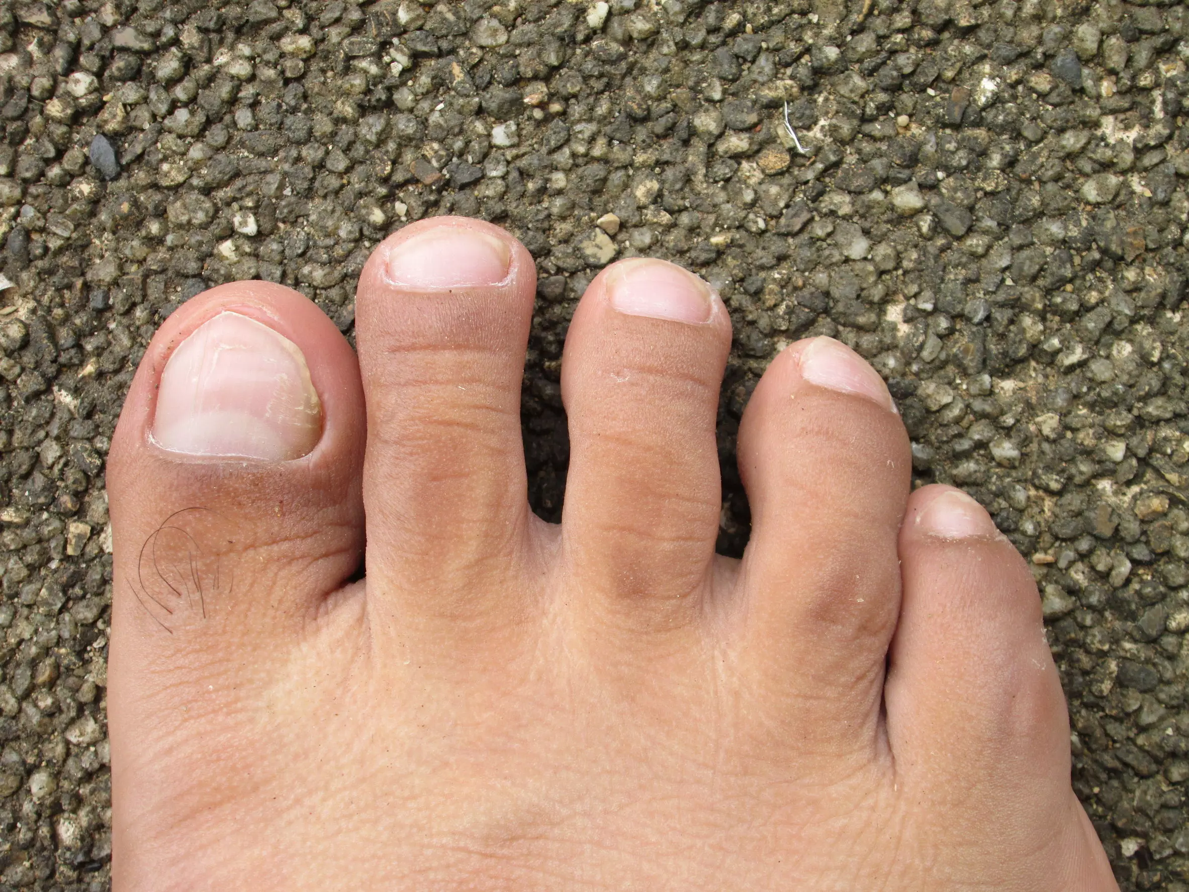 Dedos deformes de los pies