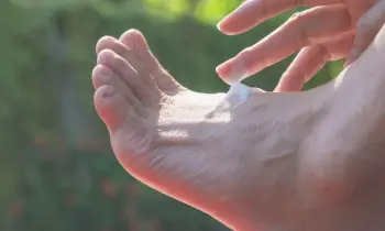 La falta de protector solar en los pies también causa cáncer de piel